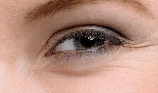 Rides dans les coins des yeux